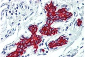 Human Breast (formalin-fixed, paraffin-embedded) stained with KRT19 antibody ABIN396942 at 10 ug/ml followed by biotinylated anti-mouse IgG secondary antibody ABIN481714, alkaline phosphatase-streptavidin and chromogen. (Cytokeratin 19 抗体)