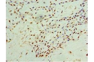 Immunohistochemistry of paraffin-embedded human breast cancer using ABIN7156601 at dilution of 1:100 (IFNGR1 抗体  (AA 270-489))