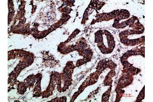 Immunohistochemical analysis of paraffin-embedded human-colon-cancer, antibody was diluted at 1:200 (GREM2 抗体  (AA 71-120))