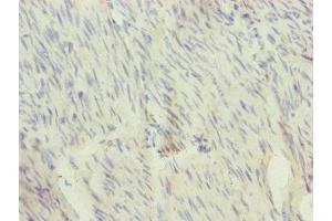 Immunohistochemistry of paraffin-embedded human bladder cancer using ABIN7166110 at dilution of 1:100 (SFI1 抗体  (AA 1003-1242))