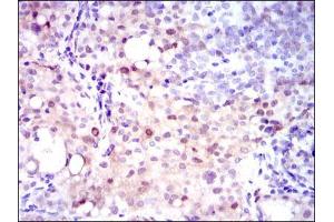 Immunohistochemical analysis of paraffin-embedded cervical cancer tissues using ASS1 mouse mAb with DAB staining. (ASS1 抗体)