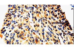 Immunohistochemistry of paraffin-embedded Human cervical cancer tissue using UTS2 Polyclonal Antibody at dilution 1:50 (Urotensin 2 抗体)