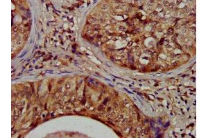 IHC image of ABIN7149534 diluted at 1:1200 and staining in paraffin-embedded human cervical cancer performed on a Leica BondTM system. (Nitrilase 1 抗体  (AA 1-243))