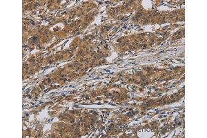 Immunohistochemistry of Human gastic cancer using INPPL1 Polyclonal Antibody at dilution of 1:40 (INPPL1 抗体)