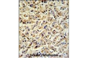 PRELP Antibody (Center) (ABIN652218 and ABIN2840925) IHC analysis in formalin fixed and paraffin embedded breast carcinoma followed by peroxidase conjugation of the secondary antibody and DAB staining. (PRELP 抗体  (AA 119-148))