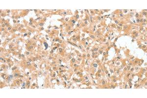 Immunohistochemistry of paraffin-embedded Human thyroid cancer using CIAPIN1 Polyclonal Antibody at dilution of 1:60 (CIAPIN1 抗体)