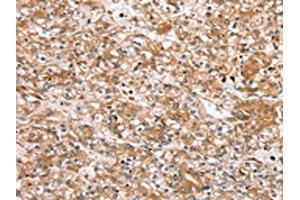 The image on the left is immunohistochemistry of paraffin-embedded Human prostate cancer tissue using ABIN7192440(SLC25A20 Antibody) at dilution 1/30, on the right is treated with synthetic peptide. (SLC25A2 抗体)