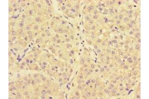 Immunohistochemistry of paraffin-embedded human liver cancer using ABIN7144725 at dilution of 1:100 (NARS 抗体  (AA 1-300))