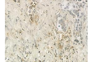 ABIN6257983 and ABIN6275857 at 1/100 staining human gastric carcinoma by IHC-P. (CAMKK2 抗体  (C-Term))