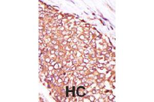 Formalin-fixed and paraffin-embedded human hepatocellular carcinoma tissue reacted with PRKCQ polyclonal antibody  , which was peroxidase-conjugated to the secondary antibody, followed by DAB staining . (PKC theta 抗体  (C-Term))