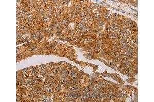 Immunohistochemistry of Human ovarian cancer using PRDX3 Polyclonal Antibody at dilution of 1:50 (Peroxiredoxin 3 抗体)