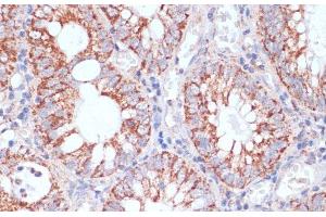 Immunohistochemistry of paraffin-embedded Human colon carcinoma using HIGD1A Polyclonal Antibody at dilution of 1:100 (40x lens). (HIGD1A 抗体)