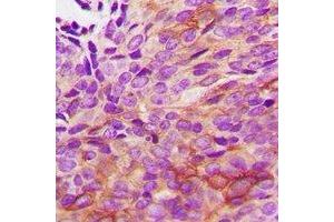 Immunohistochemical analysis of HSPB2 staining in human renal cancer formalin fixed paraffin embedded tissue section. (HSPB2 抗体  (C-Term))