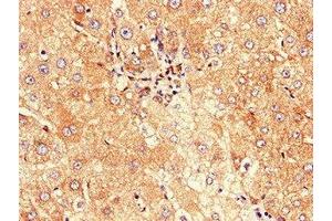 Immunohistochemistry of paraffin-embedded human liver cancer using ABIN7147128 at dilution of 1:100 (CD177 抗体  (AA 22-321))