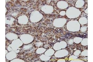 Immunoperoxidase of monoclonal antibody to STX6 on formalin-fixed paraffin-embedded human malignant lymphoma, diffuse large B tissue. (Syntaxin 6 抗体  (AA 1-255))