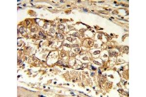 IHC analysis of FFPE human breast carcinoma with MCL1 antibody (MCL-1 抗体  (AA 191-226))