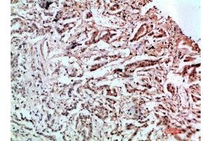 Immunohistochemical analysis of paraffin-embedded human-stomach-cancer, antibody was diluted at 1:200 (L1CAM 抗体  (AA 151-200))