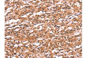 The image on the left is immunohistochemistry of paraffin-embedded Human thyroid cancer tissue using ABIN7190731(GABRA1 Antibody) at dilution 1/30, on the right is treated with synthetic peptide. (GABRA1 抗体)
