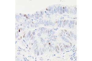 Immunohistochemistry of paraffin-embedded human colon carcinoma using [KO Validated] p53 Rabbit mAb (ABIN7271080) at dilution of 1:100 (40x lens). (p53 抗体)
