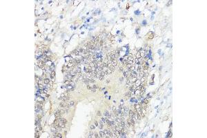 Immunohistochemistry of paraffin-embedded human colon carcinoma using GPX2 antibody (ABIN7267435) at dilution of 1:100 (40x lens). (Glutathione Peroxidase 2 抗体  (AA 100-180))