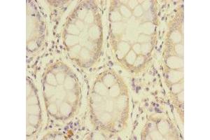 Immunohistochemistry of paraffin-embedded human colon cancer using ABIN7176692 at dilution of 1:100