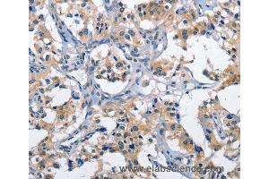 Immunohistochemistry of Human thyroid cancer using CLEC2D Polyclonal Antibody at dilution of 1:60 (CLEC2D 抗体)