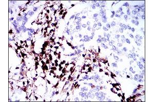 Immunohistochemical analysis of paraffin-embedded breast cancer tissues using PTPRC mouse mAb with DAB staining. (CD45 抗体  (AA 928-989))
