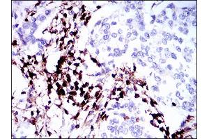 Immunohistochemical analysis of paraffin-embedded breast cancer tissues using PTPRC mouse mAb with DAB staining.