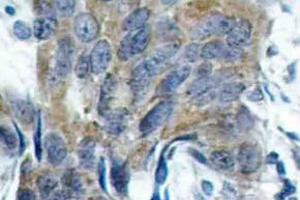 Immunohistochemistry (IHC) analyzes of p-Catenin-beta antibody in paraffin-embedded human colon carcinoma tissue. (CTNNB1 抗体  (pSer33))