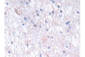 Detection of GLTP in Human Glioma Tissue using Polyclonal Antibody to Glycolipid Transfer Protein (GLTP) (GLTP 抗体  (AA 2-209))