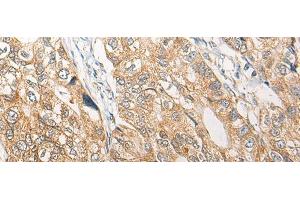 Immunohistochemistry of paraffin-embedded Human gastric cancer tissue using RGN Polyclonal Antibody at dilution of 1:25(x200) (Regucalcin 抗体)