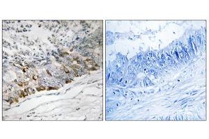 Immunohistochemistry analysis of paraffin-embedded human colon carcinoma tissue using GCHFR antibody. (GCHFR 抗体  (Internal Region))