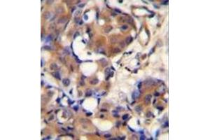 Immunohistochemistry analysis in formalin fixed and paraffin embedded human breast carcinoma reacted with Kininogen-1 Antibody (N-term) followed which was peroxidase conjugated to the secondary antibody and followed by DAB staining. (KNG1 抗体  (N-Term))