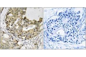Immunohistochemistry analysis of paraffin-embedded human breast carcinoma tissue, using NXPH1 Antibody. (Neurexophilin 1 抗体  (AA 77-126))