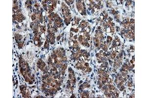 Immunohistochemical staining of paraffin-embedded Carcinoma of liver tissue using anti-PSMC3 mouse monoclonal antibody. (PSMC3 抗体)