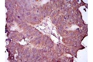 Immunohistochemical analysis of paraffin-embedded rectum cancer tissues using EGFR mutant mouse mAb with DAB staining. (EGFR Mutant (AA 693-893) 抗体)