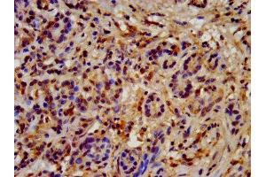 IHC image of ABIN7154923 diluted at 1:200 and staining in paraffin-embedded human pancreatic cancer performed on a Leica BondTM system. (HSP9AB1 (AA 150-355) 抗体)