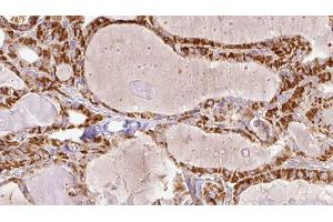ABIN6267203 at 1/100 staining Human thyroid cancer tissue by IHC-P.