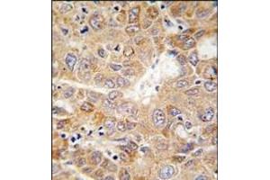 Formalin-fixed and paraffin-embedded human hepatocarcinoma tissue reacted with PGK1 antibody (Center), which was peroxidase-conjugated to the secondary antibody, followed by DAB staining. (PGK1 抗体  (Middle Region))