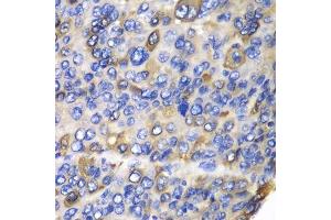 Immunohistochemistry of paraffin-embedded human liver cancer using CES1 antibody. (CES1 抗体  (AA 287-566))