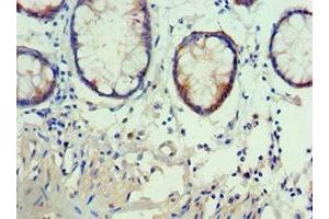 Immunohistochemistry of paraffin-embedded human colon cancer using ABIN7142909 at dilution of 1:100 (AKAP5 抗体  (AA 1-270))