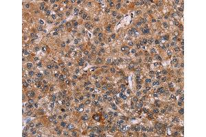 Immunohistochemistry of Human liver cancer using EGR4 Polyclonal Antibody at dilution of 1:20 (EGR4 抗体)