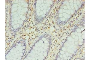 Immunohistochemistry of paraffin-embedded human colon cancer using ABIN7145489 at dilution of 1:100 (ENO3 抗体  (AA 7-432))