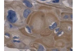 IHC-P analysis of Human Colorectal cancer Tissue, with DAB staining. (GDF11 抗体  (AA 138-386))