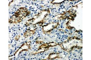 IHC-P: Aquaporin 4 antibody testing of human lung cancer tissue (Aquaporin 4 抗体  (AA 258-27))