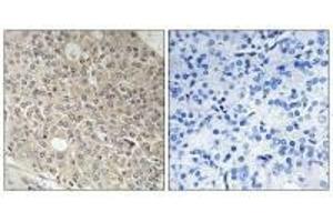 Immunohistochemistry analysis of paraffin-embedded human prostate carcinoma tissue using AMOTL1 antibody. (AMOTL1 抗体)