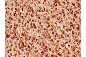 IHC image of ABIN7166287 diluted at 1:200 and staining in paraffin-embedded human glioma performed on a Leica BondTM system.