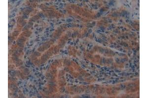 Detection of GPX4 in Human Thyroid cancer Tissue using Polyclonal Antibody to Glutathione Peroxidase 4 (GPX4) (GPX4 抗体  (AA 74-197))