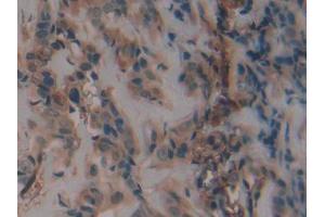 DAB staining on IHC-P; Samples: Human Breast cancer Tissue (PAI1 抗体  (AA 25-402))