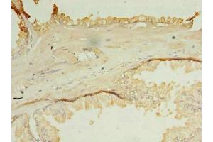 Immunohistochemistry of paraffin-embedded human prostate cancer using ABIN7162127 at dilution of 1:100 (OCIAD1 抗体  (AA 1-245))